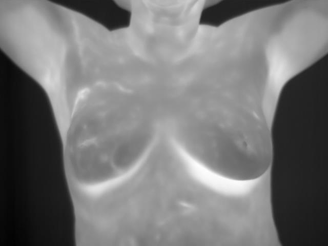 Breast Cancer Detection Using Thermal Infrared Images