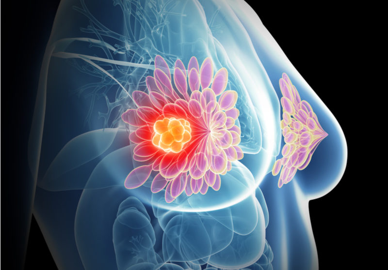 Artificial Intelligence As A Diagnostic Tool In Breast Cancer Thermography